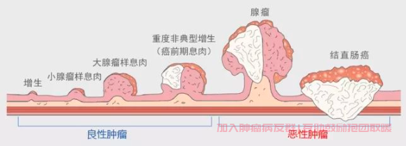 肿瘤群答疑,出现肠息肉会演变成肠癌吗？